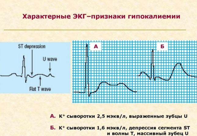 gipokaliemiya-ne…liya-v-organizme risunok Гипокалиемия (нехватка калия в организме)