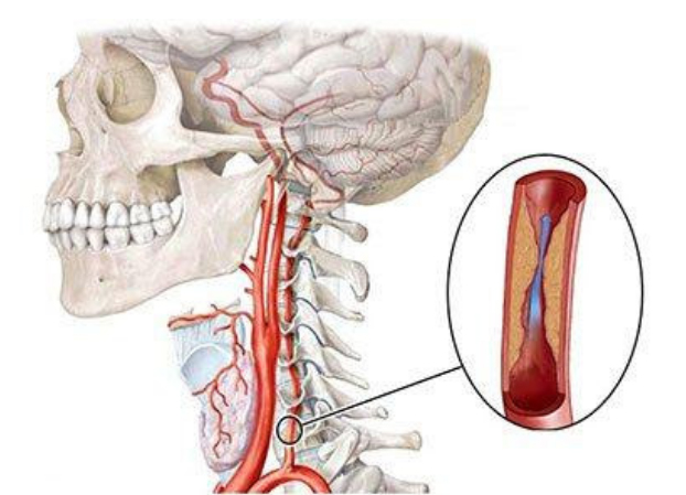 gipoplaziya-prav…onochnoj-arterii sxema Гипоплазия правой и левой позвоночной артерии
