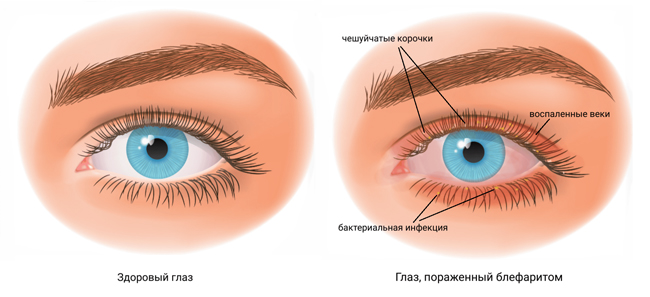 Глаз с блефаритом Глаз с блефаритом