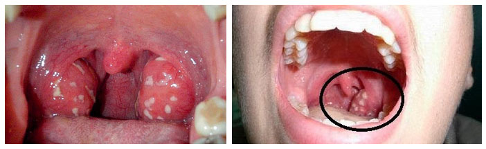 gnojnye-probki-b…ichenie-mindalin foto 2 Гнойные пробки, белый налет, воспаление и увеличение миндалин