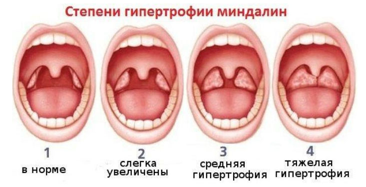 gnojnye-probki-b…ichenie-mindalin gipertrofia Гнойные пробки, белый налет, воспаление и увеличение миндалин
