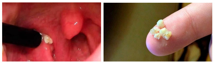 gnojnye-probki-b…ichenie-mindalin probki Гнойные пробки, белый налет, воспаление и увеличение миндалин