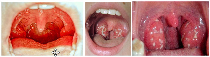 gnojnye-probki-b…ichenie-mindalin u detey Гнойные пробки, белый налет, воспаление и увеличение миндалин