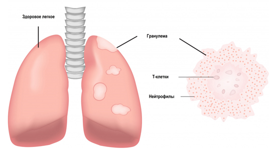 Гранулемы в ткани легких Гранулемы в ткани легких
