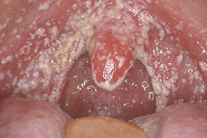 gribok-v-gorle primer Грибок в горле