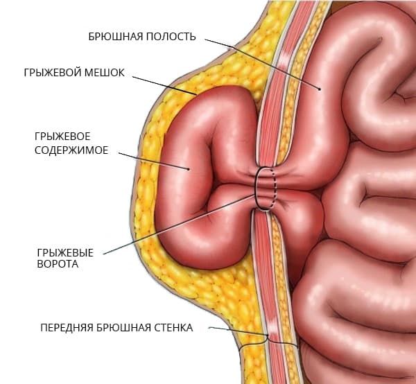 gryzha-zhivota 1 Грыжа живота