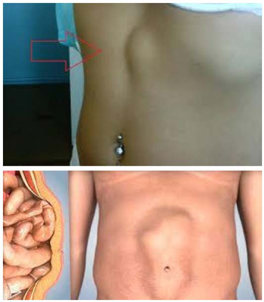 gryzha-zhivota 3 Грыжа живота