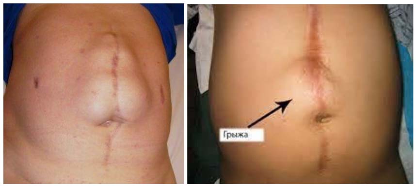 gryzha-zhivota 4 Грыжа живота