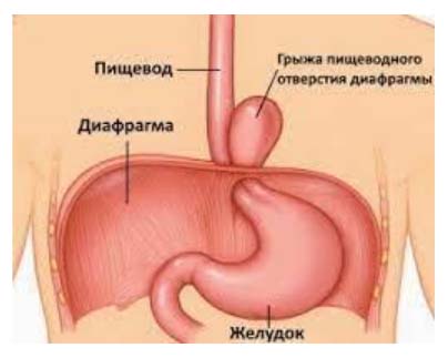 gryzha-zhivota 5 Грыжа живота