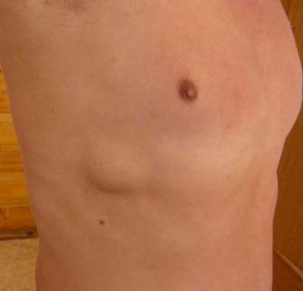 gryzha-zhivota 6 Грыжа живота