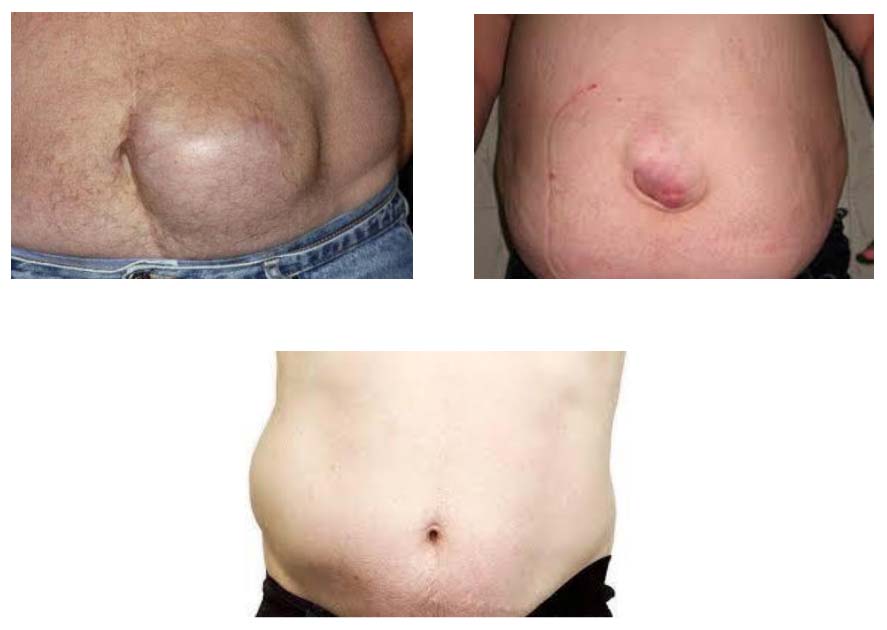 gryzha-zhivota 7 Грыжа живота