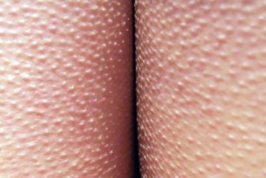 Фото гусиной кожи на ногах Фото гусиной кожи на ногах