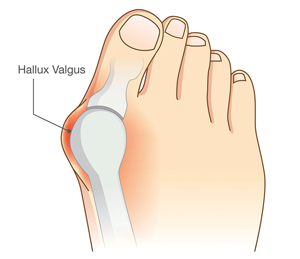 Косточка на большом пальце ноги Косточка на большом пальце ноги