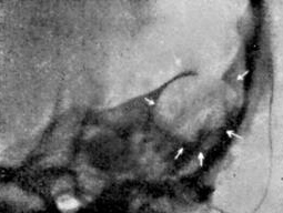 Холестеатома левого уха с разрушением верхнего края пирамиды