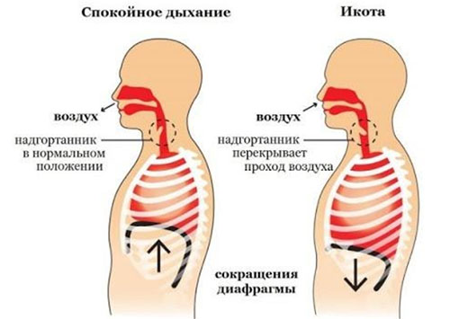 ikota-u-novorozhdennyh mexanizm Икота у новорожденных