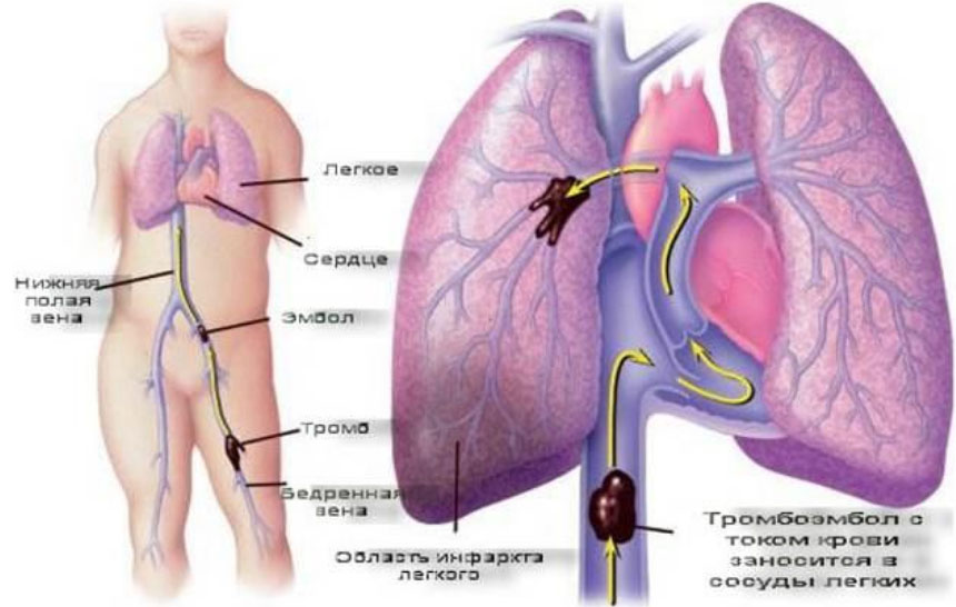 infarkt-legkogo 1 Инфаркт легкого