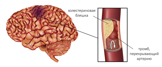 Ишемический инсульт Ишемический инсульт