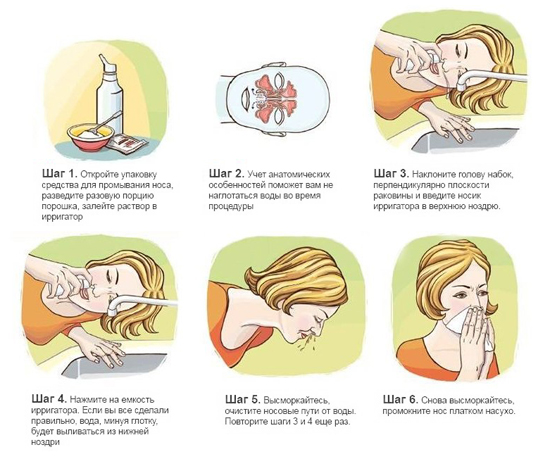 Правильная методика промывания носа водой или растворами Правильная методика промывания носа водой или растворами