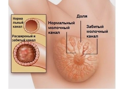 Как проявляется лактостаз Как проявляется лактостаз