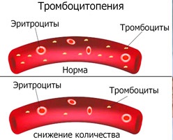 Как проявляется тромбоцитопения Как проявляется тромбоцитопения