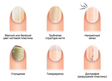 Как распознать грибок ногтей Как распознать грибок ногтей