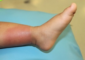 Как выглядит рожа на ноге, фото начальной стадии Как выглядит рожа на ноге, фото начальной стадии