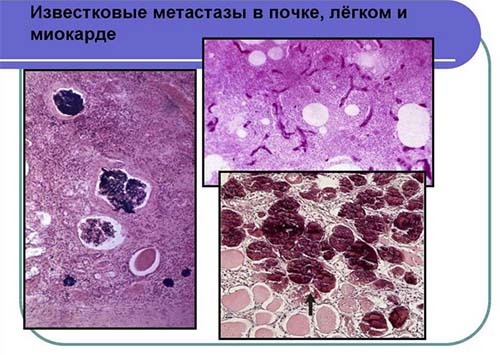 kalczinoz metastazy Кальциноз