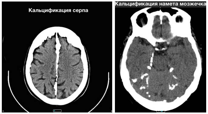 kalczinoz mozga Кальциноз