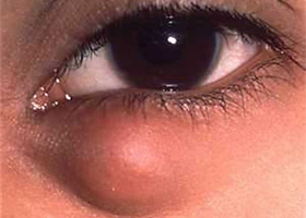 kista glaza Киста