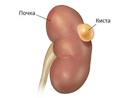 Киста почки Киста почки