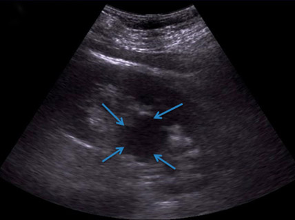 Киста почки Киста почки