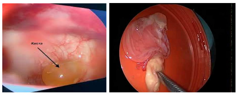 kista-v-nosu-ver…elyustnoj-pazuhi 1 Киста в носу (верхнечелюстной пазухи)