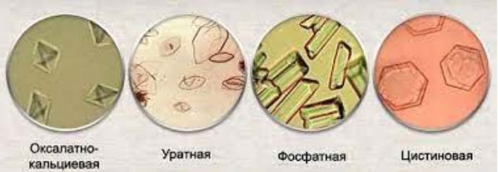 kristalluriya-solevoj-diatez 1 Кристаллурия (солевой диатез)
