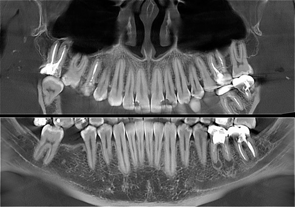 Компьютерная томография зубов Компьютерная томография зубов