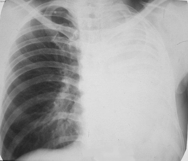 Тотальный ателектаз левого легкого