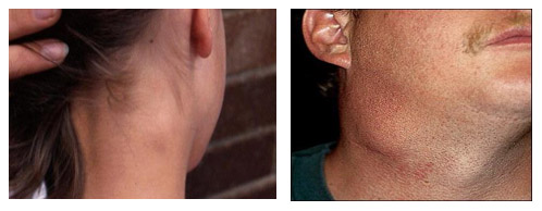 Лимфаденопатия Лимфаденопатия