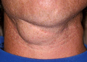 Лимфаденопатия Лимфаденопатия