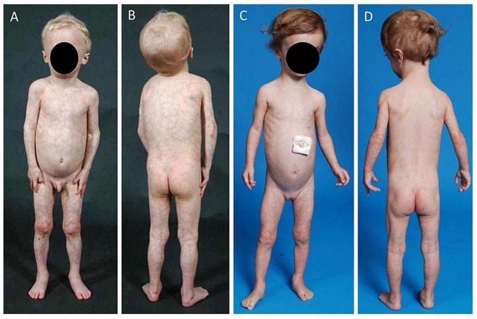 lipodistrofiya-i-bolezn-uippla 1 Липодистрофия и болезнь Уиппла