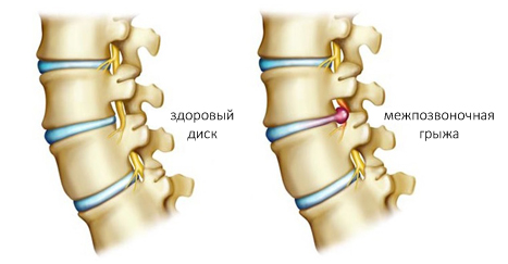 Межпозвоночная грыжа Межпозвоночная грыжа