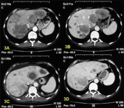 metastazy-v-pecheni rentgen Метастазы в печени