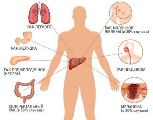 metastazy-v-pecheni sxema Метастазы в печени
