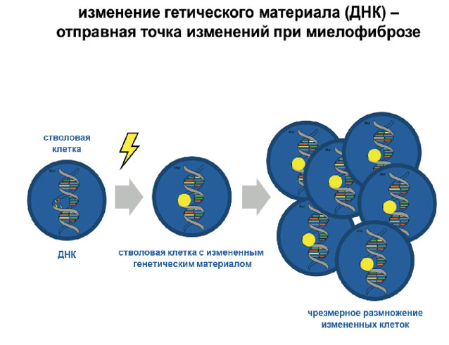 Миелофиброз Миелофиброз