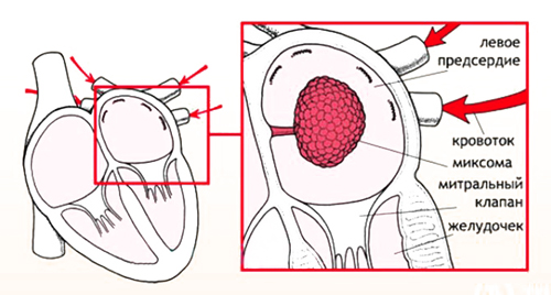Миксома в левом предсердии Миксома в левом предсердии