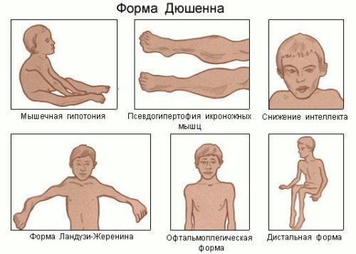 Миопатия (мышечная дистрофия) Миопатия (мышечная дистрофия)