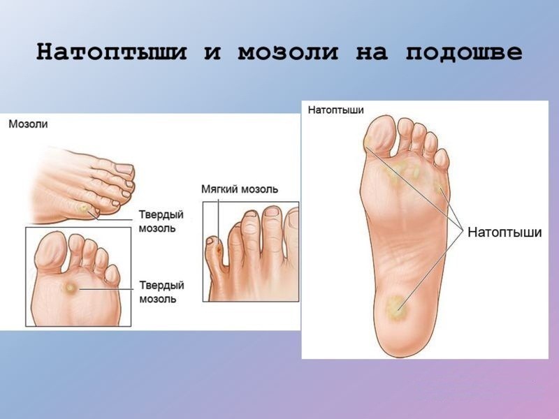 mozol vidyy Мозоль