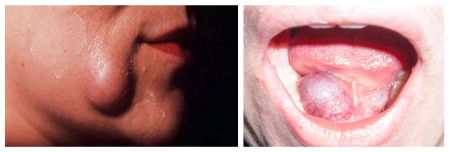 mukoczele 2 Мукоцеле