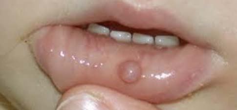 mukoczele 3 Мукоцеле