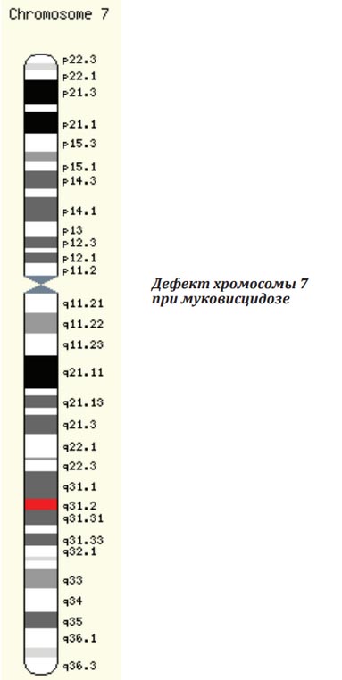 mukovisczidoz-kistoznyj-fibroz 7 xromosoma Муковисцидоз (кистозный фиброз)