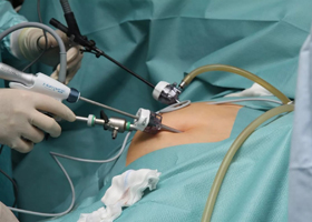 Проведение операции нефропексии лапароскопическим методом Проведение операции нефропексии лапароскопическим методом