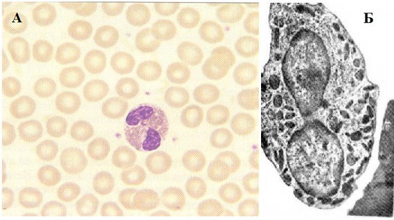 Эозинофильный гранулоцит: А — мазок крови, Б — электронная микроскопия Эозинофильный гранулоцит: А — мазок крови, Б — электронная микроскопия